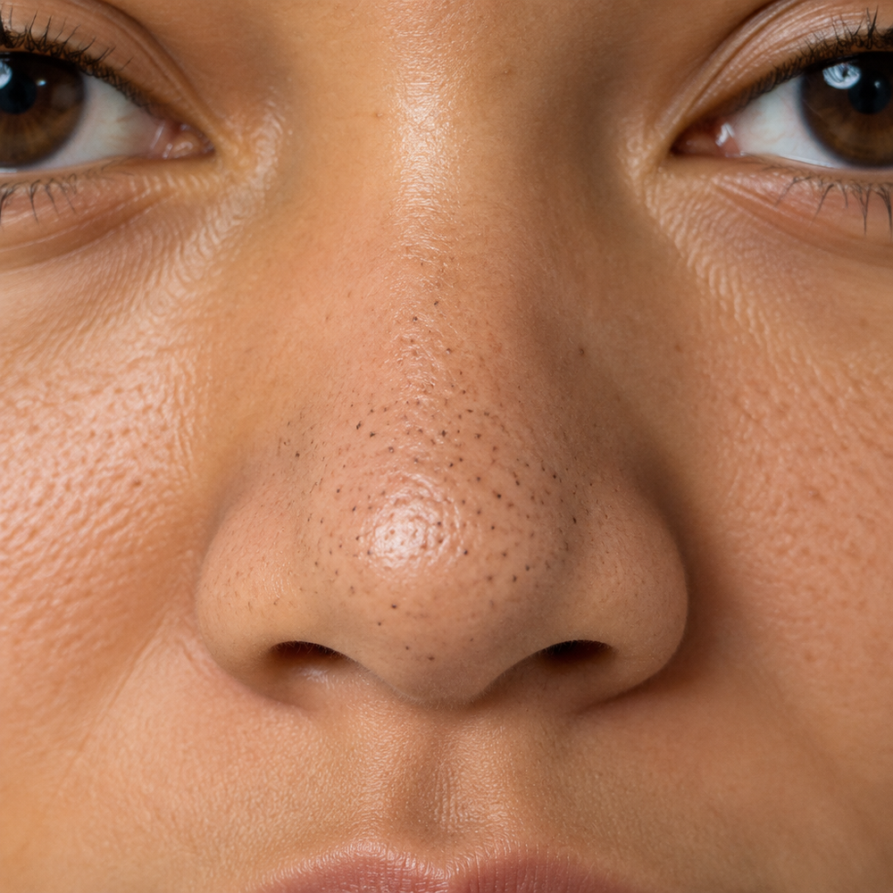 Before image showing visible pores and blackheads
